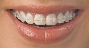 Behel Ceramic