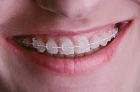 Behel Sapphire