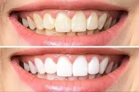 Bleaching